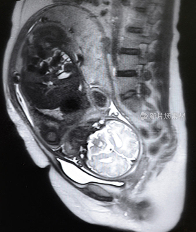 胎儿和孕妇MRI T2体重图像